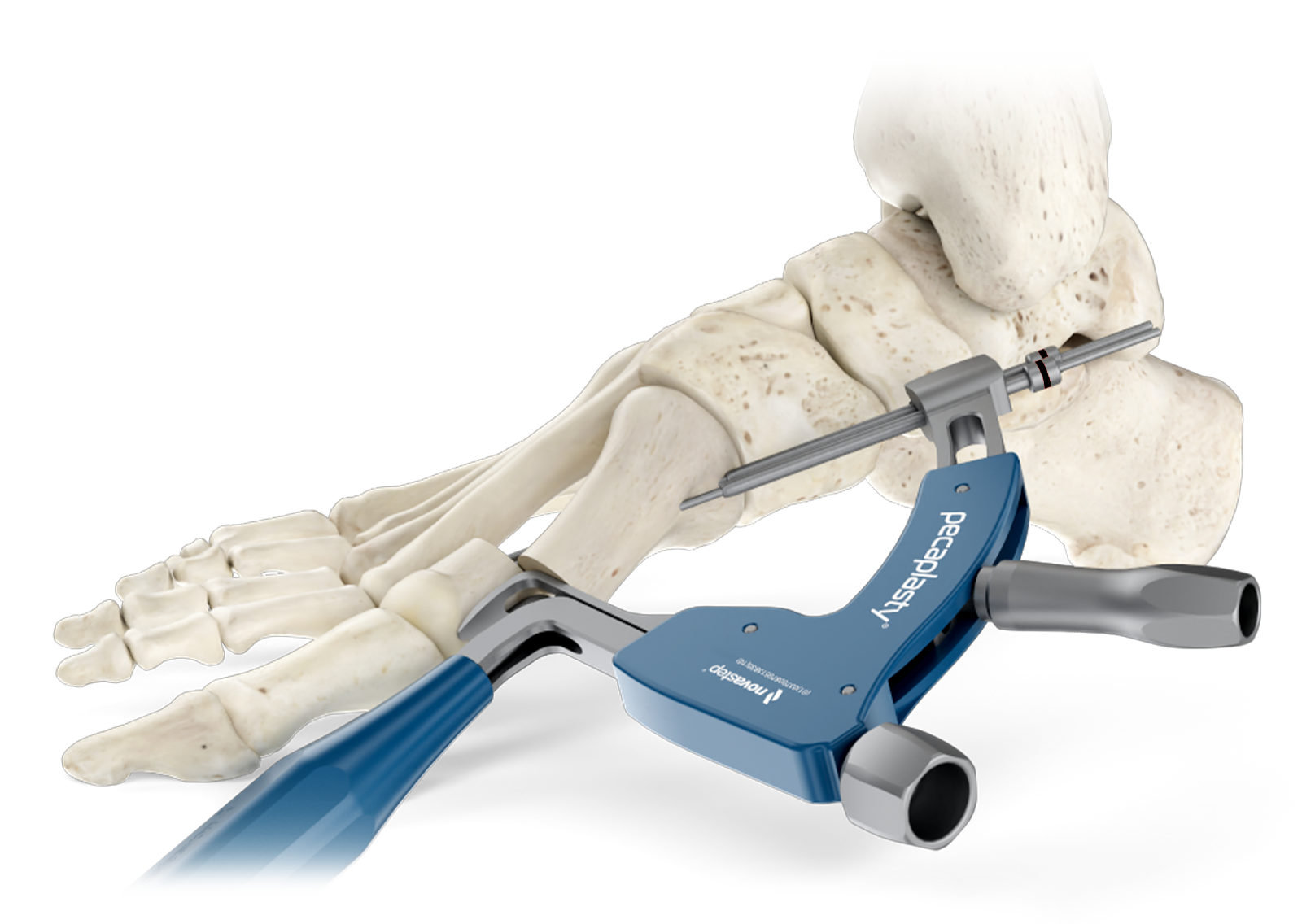Banner-Lapidus-Plantar