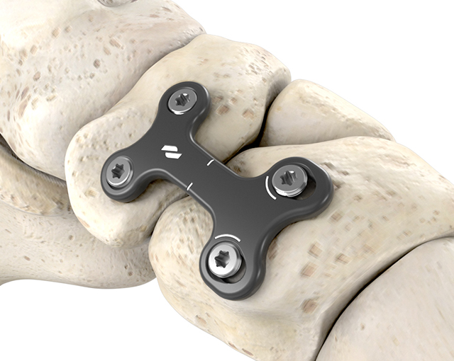 tarsectomy