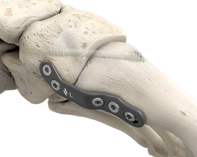 Lapidus-plantar-implanted