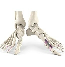 Forefoot Rollover (1)